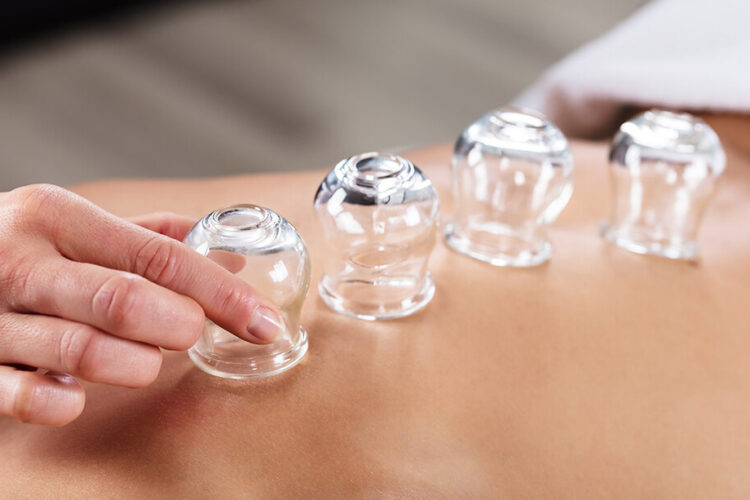 Cupping Massage Therapy